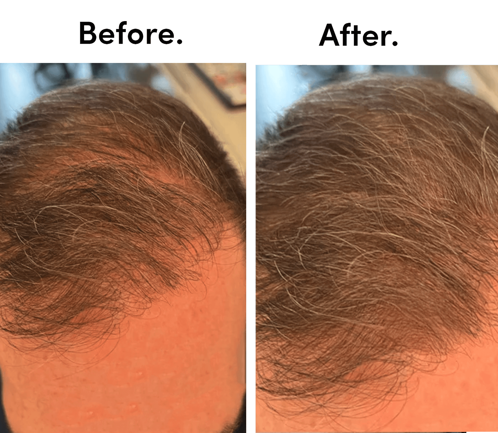 HAIR THICKENING 101 | THE EFFECTIVE COMBINATION