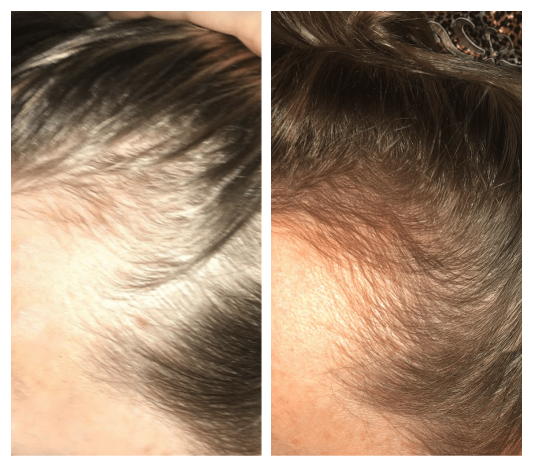 hair tent 3-STEP HAIR THICKENING – TenT